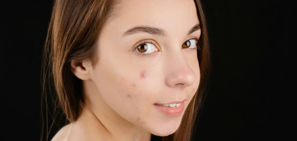 Does Whey Protein Cause Acne?