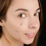 Does Whey Protein Cause Acne?